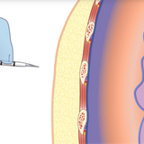 My Medic - Decompression Needle, Life-Saving Tension Pneumothorax Treatment